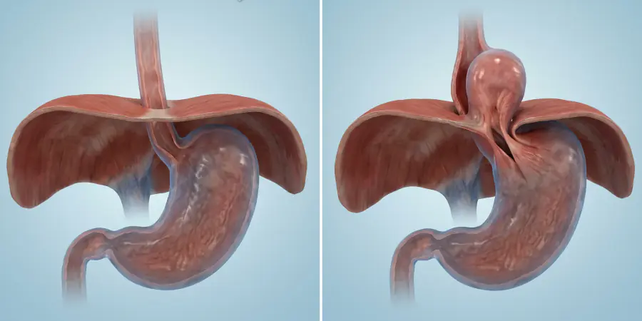 Ilustración de hernia hiatal antes y después de la cirugía para reflujo gastroesofágico